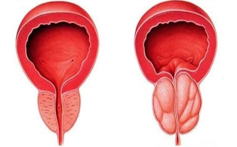 gesunde und entzündete Prostata mit Prostatitis