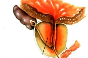 Was ist Prostatitis bei Männern