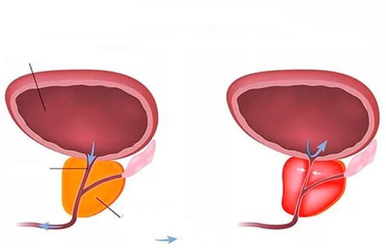 normale und entzündete Prostata